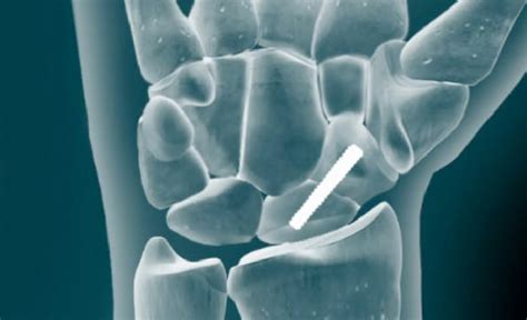 Scaphoid Fracture Surgery (Open Reduction and Internal Fixation, ORIF)