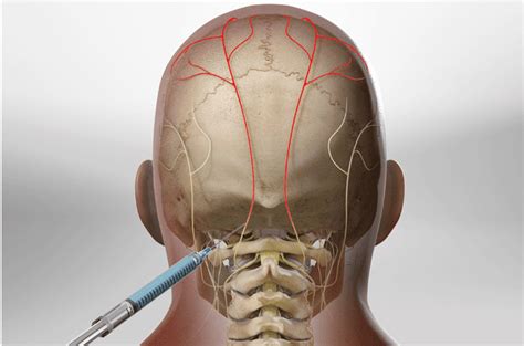 Lesser Occipital Nerve Blocks Coding