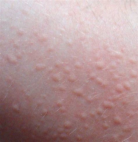 Skin Imperfection Skin Allergy Urticaria Disease Red Spots On The - Vrogue
