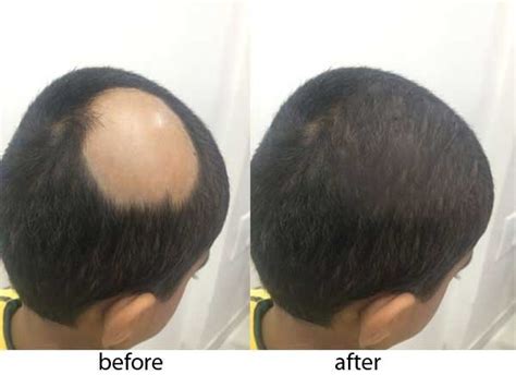 Alopecia Areata – Know the Symptoms, Causes and Treatment