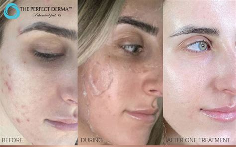 THE PERFECT DERMA PEEL RX AFTER-CARE - Hayes Valley Medical Esthetics