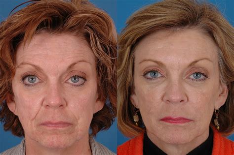 Patient 1 Sculptra Before and After - Dallas Advanced Facial Plastic ...