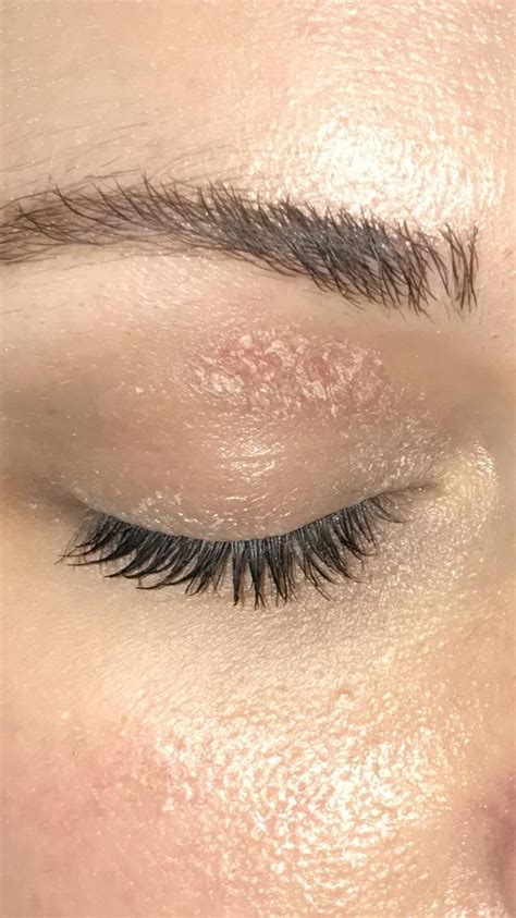 [Skin Concern] What is this patch on my eyelid? How do I treat it? It's ...