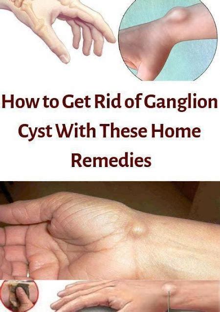 How to get rid of ganglion cysts with this home remedies? - Healthy Lifestyle