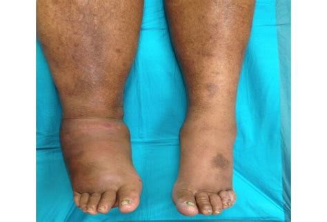 Type 2 Diabetes Leg Swelling - ScienceHUB