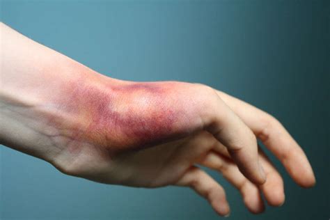 What Is Wrist Sprain Here Are Its Symptoms Causes Tre - vrogue.co