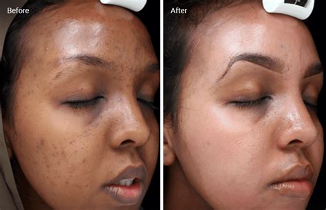 Chemical Peels for Acne Scars: Efficacy, Before and Afters, At-Home Uses