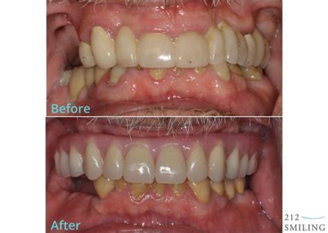 Male All on 4 Before and After Photos - 212 Smiling