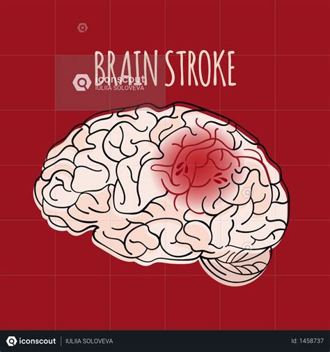 Best Premium BRAIN STROKE Illustration download in PNG & Vector format | Illustration, Vector ...