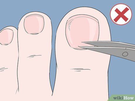 How to Treat an Infected Hangnail + Future Prevention