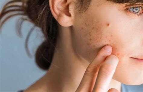 Blackheads On Cheeks: Causes, Home Remedies, & Preventive Tips