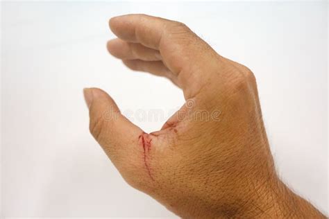 Fresh Wound from a Sickle Cut on the Thumb. Stock Image - Image of gesturing, isolated: 254328553