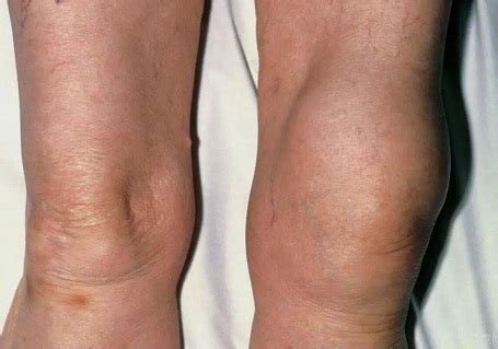 Swelling On Top Of Knee: Causes & Treatment