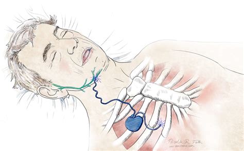 Chest Implant for Sleep Apnea - Portfolio - SayoStudio