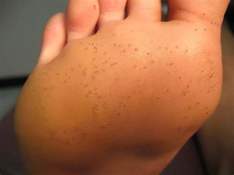 Holes In Skin On Bottom Of Feet | Images and Photos finder