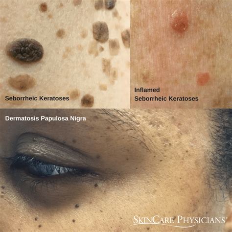 A guide to common skin growths, seborrheic keratoses | SkinCare Physicians