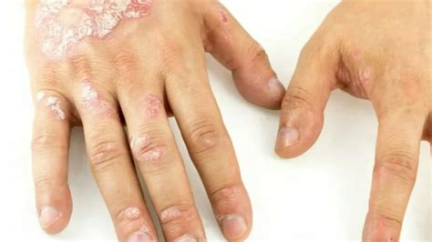 Understanding Plaque Psoriasis: Causes, Symptoms, and Treatments - Pharmadoctor.co.uk: Your ...