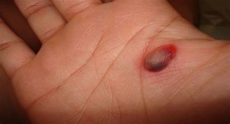 5 effective home remedies to get rid of blood blisters | TheHealthSite.com