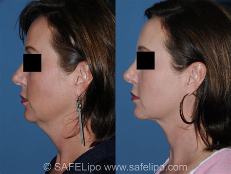 Double Chin Reduction Before and After Pictures Case 349 | SAFELipo®