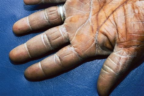 Pictures of 15 Uncommon Skin Conditions