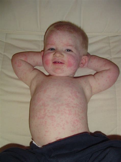 Healthtalk: Fifth Disease or Erythema Infectiosum