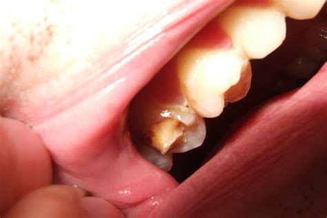 How to Fix Cracked Tooth: Causes, Symptoms, & Treatments