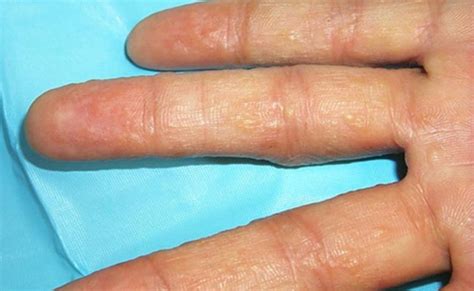 Pompholyx Dyshidrotic Eczema Dyshidrotic Eczema Treatment – Otosection