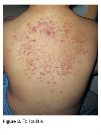 An erythematous pustular rash on the torso and limbs | Medicine Today