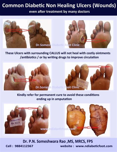 Non healing Diabetic Ulcer locations - Podiatry Doctor