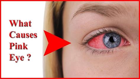 What Causes Pink Eye – Top 5 Causes of Pink Eye and Common Sources of th... | Pink eye causes ...