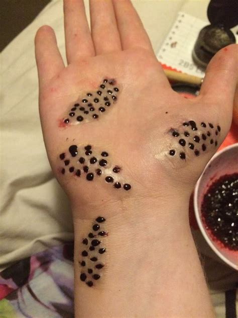 Trypophobia Skin Disease Hand