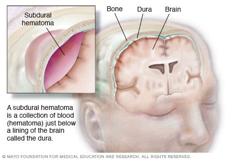 Intracranial hematoma - Mayo Clinic