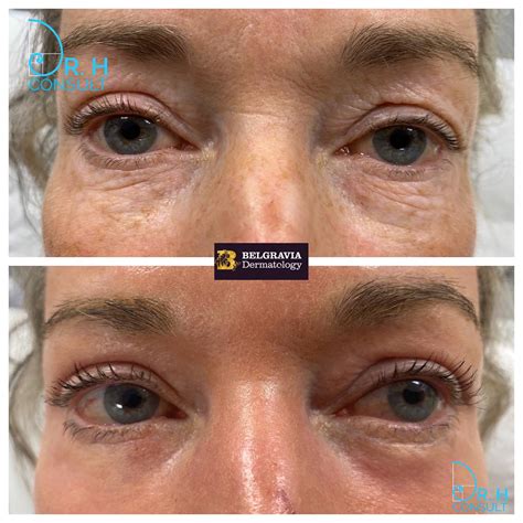 Tratamiento lineal Lirio co2 laser for under eye wrinkles Endurecer sentar Obsesión