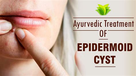 Ayurvedic Treatment for Epidermoid Cysts