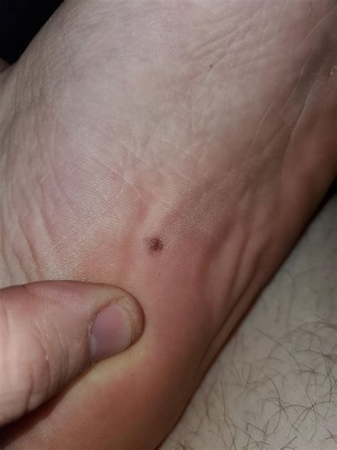 Does this mole on the bottom of my foot look like melanoma? : r/Melanoma