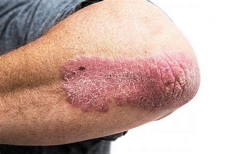 A deeper look at psoriasis - Harvard Health