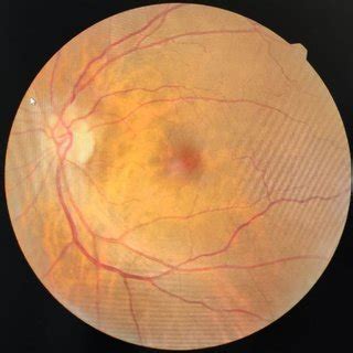 Left Eye fundus examination is unremarkable. | Download Scientific Diagram