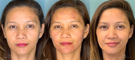 IPL Photofacial - Before & After Photos | Dr. Steve Vu