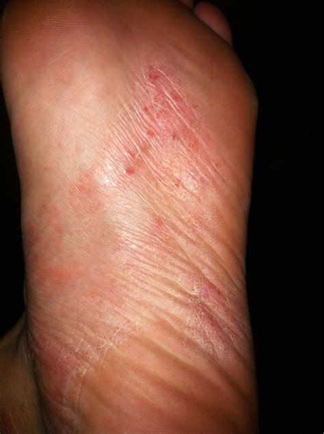 Rash/eczema on the soles of my feet? Started at the sides of my feet but seem to have migrated ...