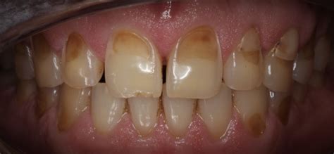 Enamel Erosion - Cheryl A. Siegel, DDS