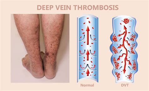 Deep Vein Thrombosis (DVT) - Vein Specialist of the Carolinas