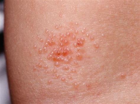 Molluscum Contagiosum: Causes, Symptoms, Treatment, And, 42% OFF