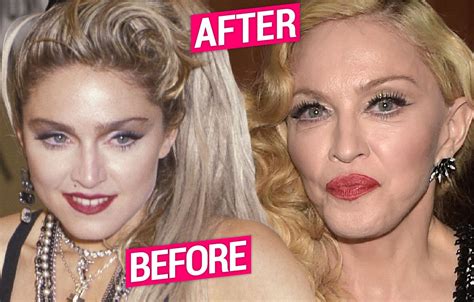 Madonna Plastic Surgery Secrets Revealed