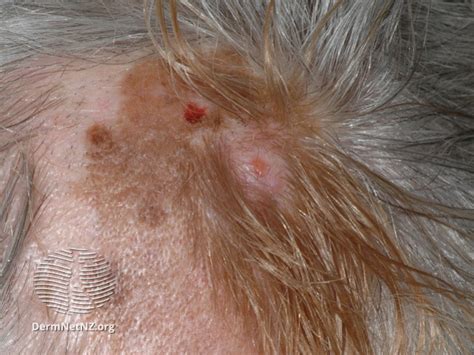 File:Desmoplastic melanoma, scalp (DermNet NZ desmoplastic-melanoma-3).jpg - NC Commons