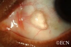 Epibulbar Conjunctival Cyst » New York Eye Cancer Center