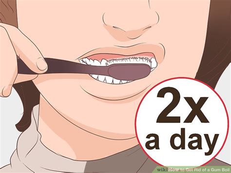 How to Get Rid of a Gum Boil: 10 Steps (with Pictures) - wikiHow