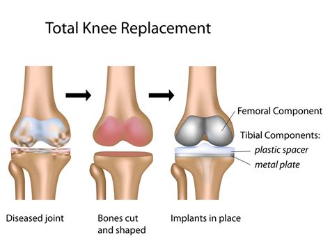 Knee Replacement Surgery (Knee Arthroplasty)