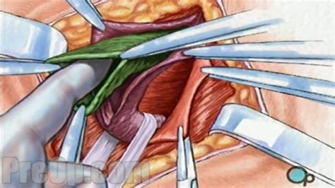 Hernia Repair Inguinal (Open) Surgery Patient Education - Uohere