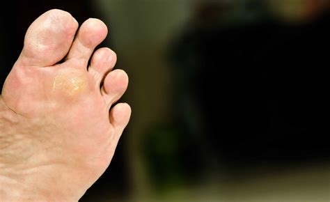 Feet warts causes. Plantar Warts: Causes, Symptoms, and Treatment ...