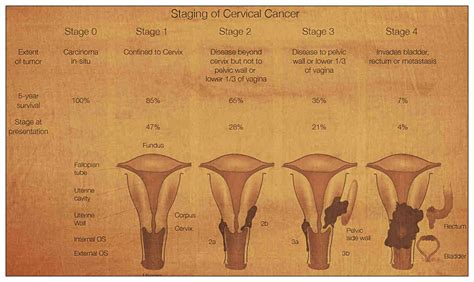 survival rates ureter cancer - SUCRAP